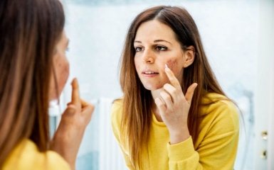 Как ухаживать за жирной и проблемной кожей лица – 9 советов косметолога