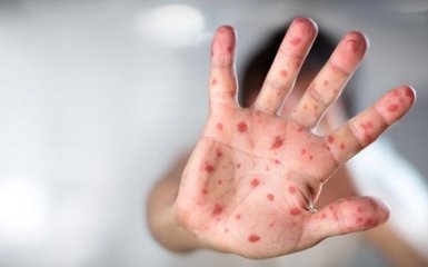 ВОЗ экстренно предупредила мир о возвращении еще одной болезни