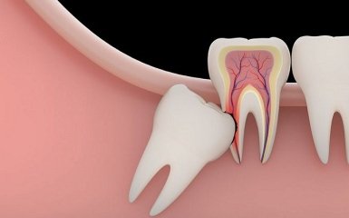 Нужно ли удалять зуб, если он постоянно болит?