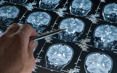 Болезнь Альцгеймера