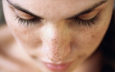 Как избавиться от пигментных пятен на лице — советы косметологов