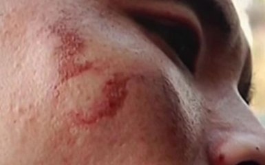 Китаец взбудоражил сеть взорвавшимся iPhone, скептики не верят: появились фото